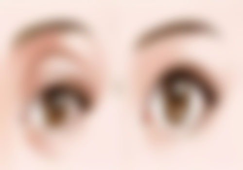 6800 元起的快乐！我在新疆威兹曼找刘丽娜做微创三点定位双眼皮，效果惊艳体验超棒！ 