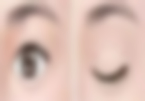 {新疆威兹曼整形外科医院刘丽娜医生做微创三点定位双眼皮6800元起，审美时尚修复强 