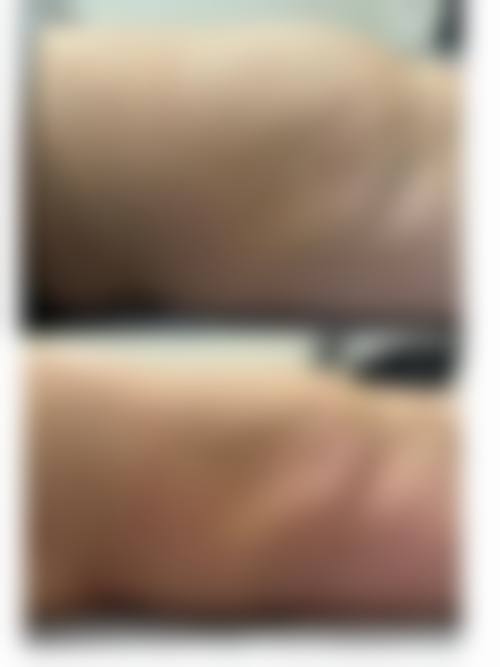 北京加减美医疗美容热拉提是溶脂还是收紧脂肪