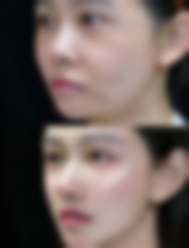 北京加减美医疗美容的瘦脸针1个月后成效靠谱吗？