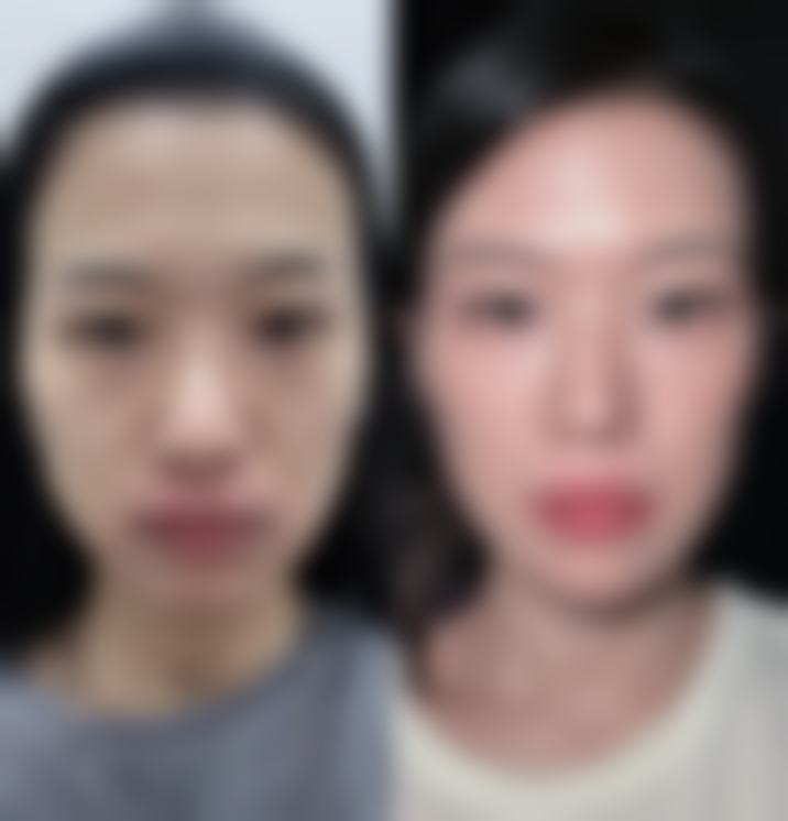 乌鲁木齐世纪亚太整形医院真实实例