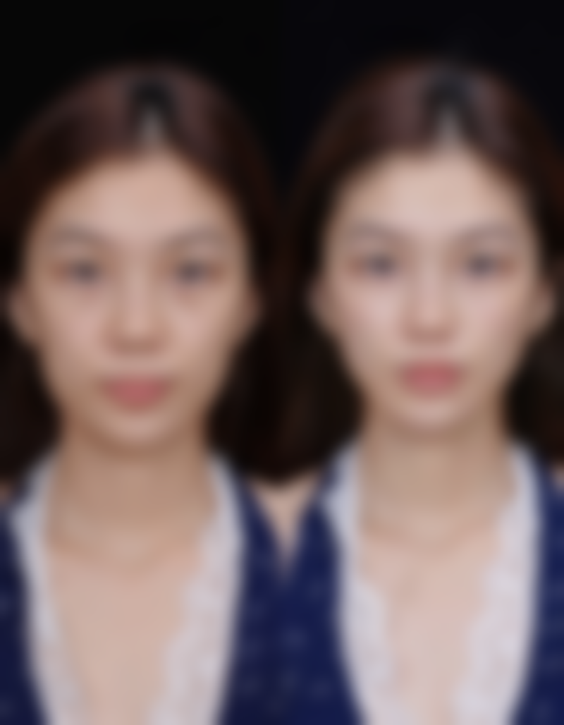 在汕头汕美医院隆鼻，不同材料价格对应的成效如何？