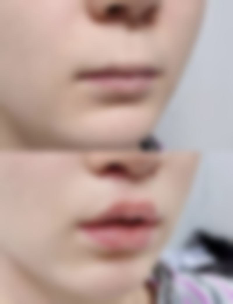 沈阳杏林整形处理烫伤疤痕疼怎么样？