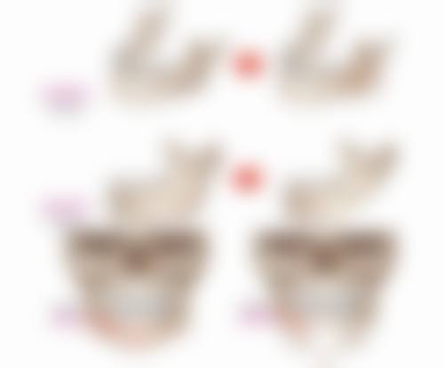 北京嘉禾医疗美容热熔无痕去眼袋靠谱吗?