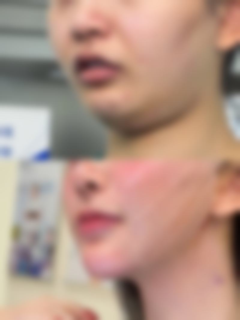 沈阳杏林整形医院治疗油烫伤疤痕黑靠谱吗