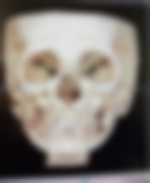 瘦脸针下巴一起打脸会变小吗？揭秘4大瘦脸真相，了解正确打法让你的脸小一圈！ 