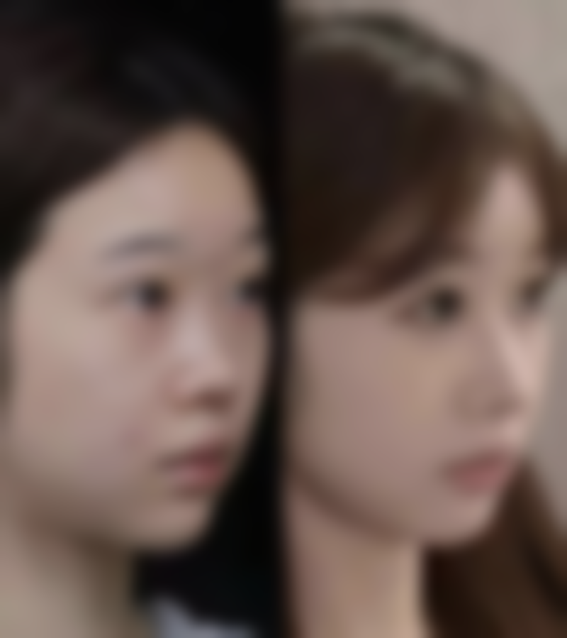 瘦脸针和下巴一起打靠谱吗