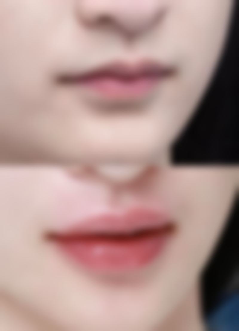 北京圣嘉新医疗美容医院淡化油烫伤疤痕黑成效好吗