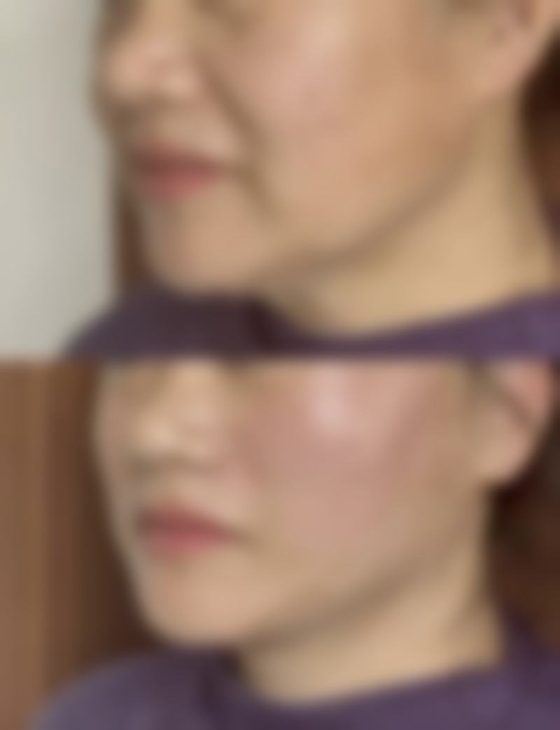 北京嘉禾医疗美容生理期割双眼皮值不值