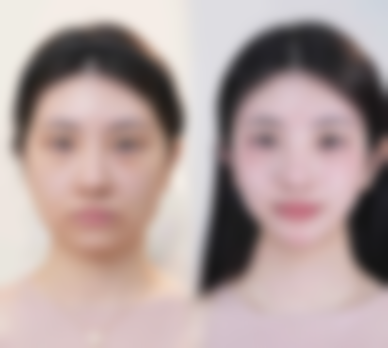 北京画美医疗美容双眼皮手术拆线后碰水时间值不值关注?