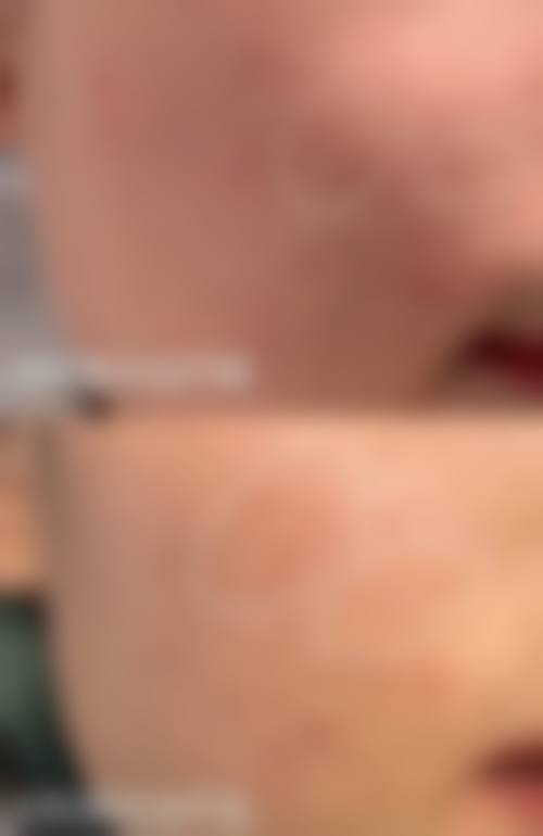 杭州艺星皮肤美容瘦脸针后打水光靠谱吗？