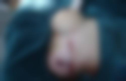 嘉禾医疗美容单眼皮变双眼皮适合什么人群