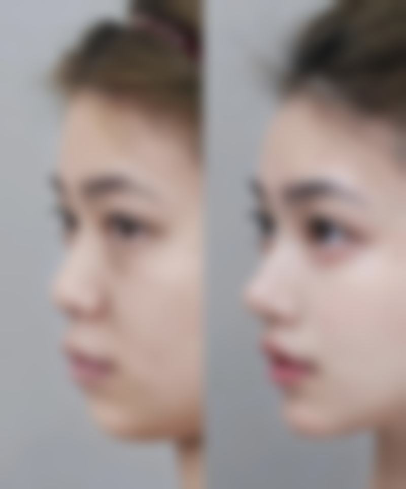 滕州美莱纯韩整形医院真实实例