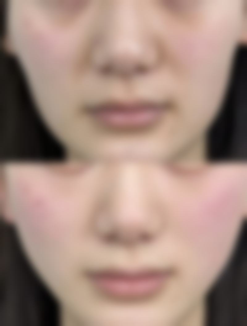 韩国JN整形肋骨隆鼻对身体的影响值不值？