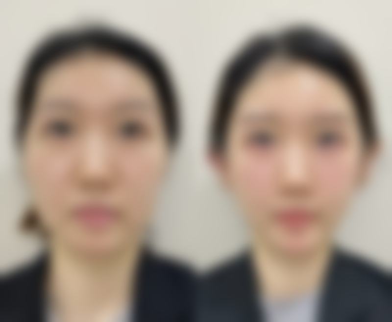 呼和浩特京美医疗美容医院做阴道紧缩术术后修复时间怎么样？