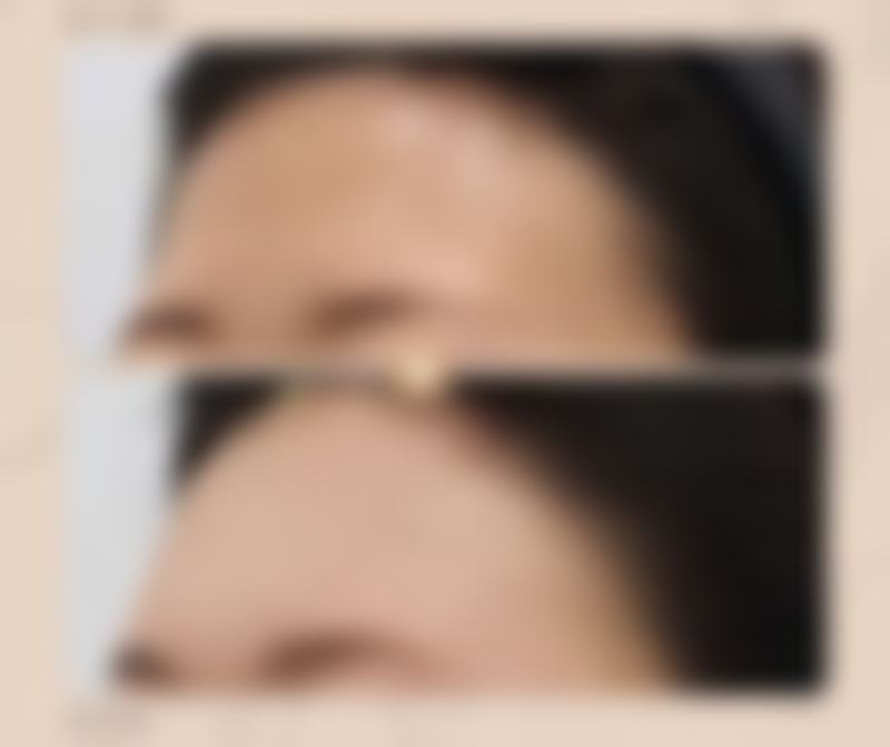 呼和浩特京美医疗美容医院改善一只双眼皮情况怎么样？