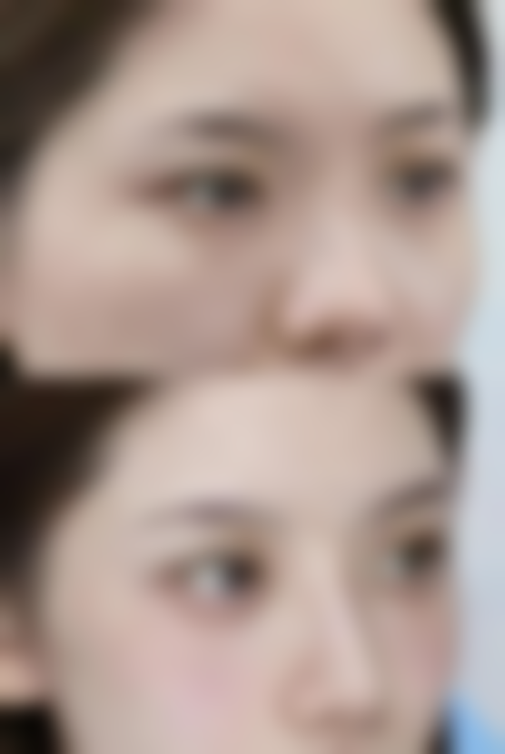 圣嘉新医疗美容医院单眼皮变双眼皮手术值不值