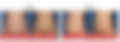 沈阳杏林整形外科医院去除疤痕体质脂肪瘤靠谱吗？