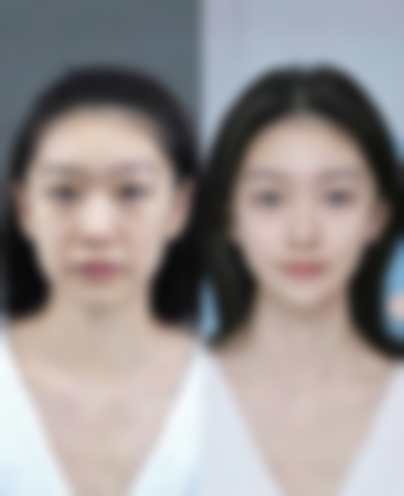 北京画美医疗美容用妙桃做隆胸成效适合我吗？