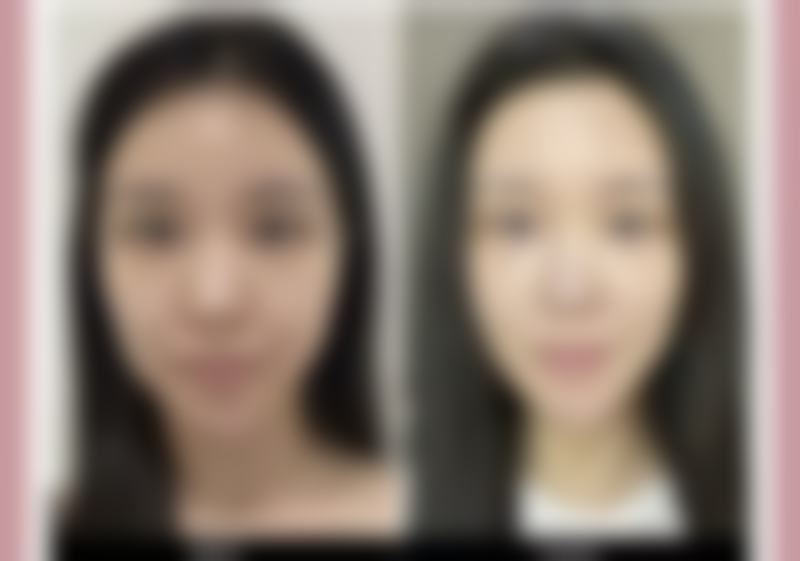 沈阳杏林整形用妙桃做隆胸成效怎么样？