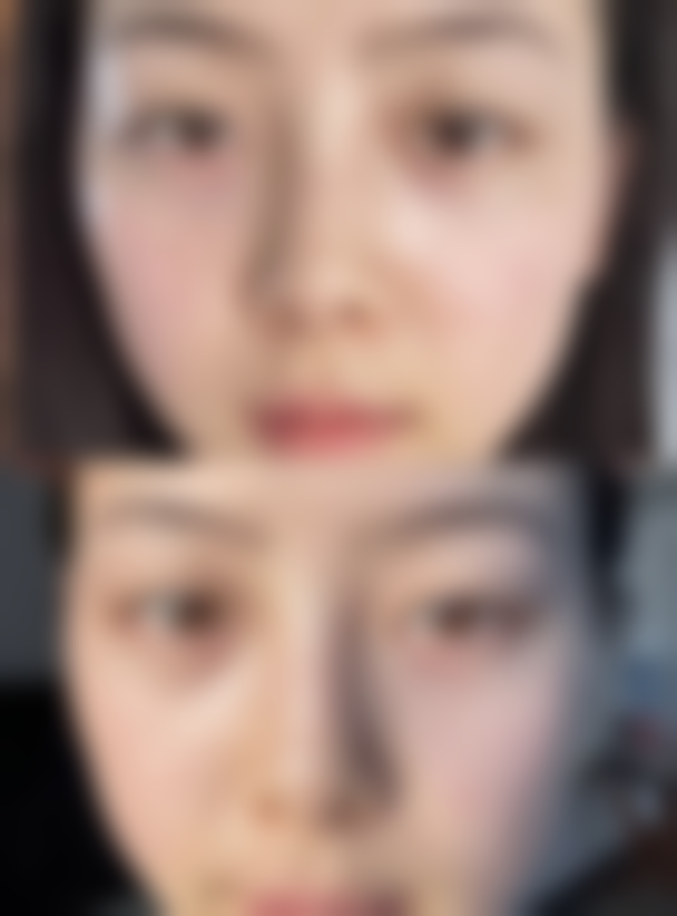 北京画美医疗美容医院处理隆胸假体破裂适合吗？