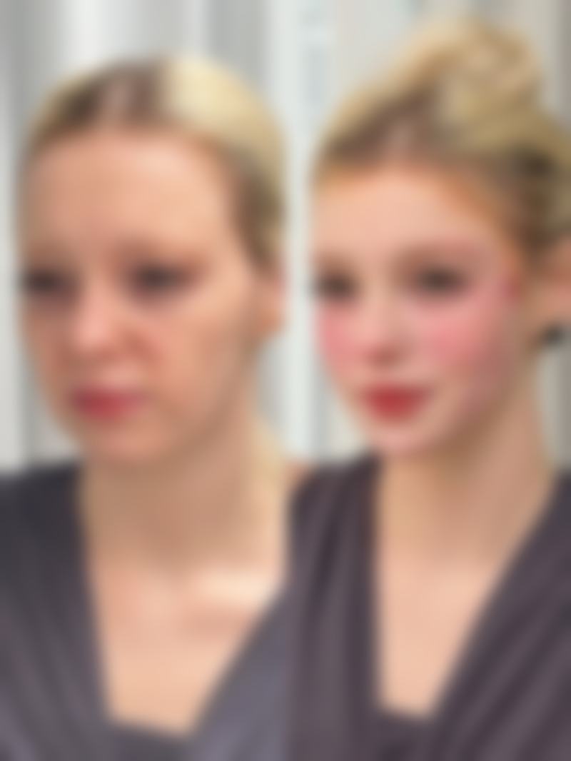 隆胸假体破裂后去北京加减美医疗美容医院怎么样？