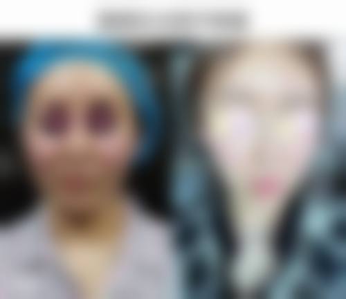 北京圣嘉新医疗美容医院双眼皮术后眼睑外翻好转几率大吗？