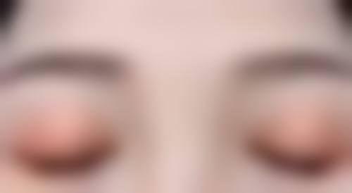 辽宁省人民医院整形外科肿眼泡割双眼皮抽脂怎么样？