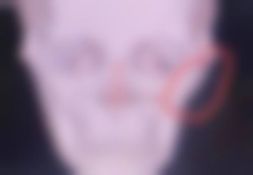 沈阳名流美容医院修复脸上疤痕成效好吗