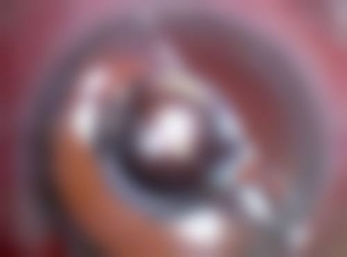 北京嘉禾医疗美容双眼皮术后眼睑外翻多久能好转？