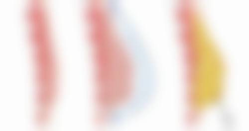 刚做完双眼皮手术眼睑外翻会好转吗？揭秘3大关键因素，解析术后恢复真相，让你安心变美！ 