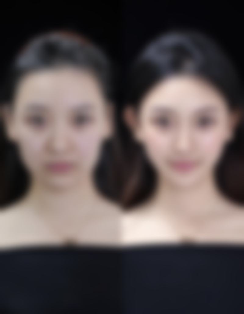 突然双眼皮肿了去沈阳北方整形医院怎么样？