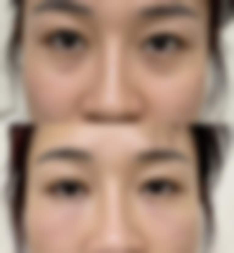 北京画美医疗美容双眼皮术后眼睑外翻好转的判断依据是什么？