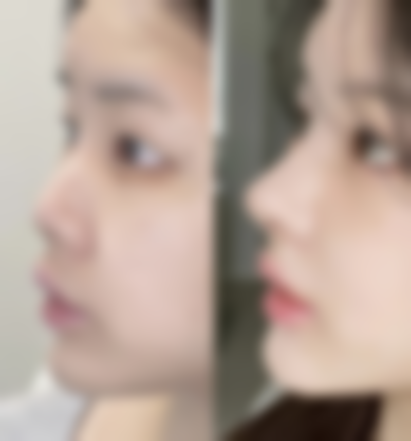 硅胶假体隆胸可以保存多久？揭秘2024年热门医美项目，正常使用可达20年以上的秘密你知道吗？ 