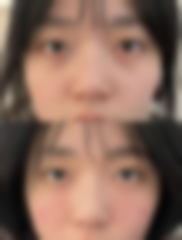 武科 大附属紫荆医院医疗美容科做全切双眼皮后怎么护理修复快？