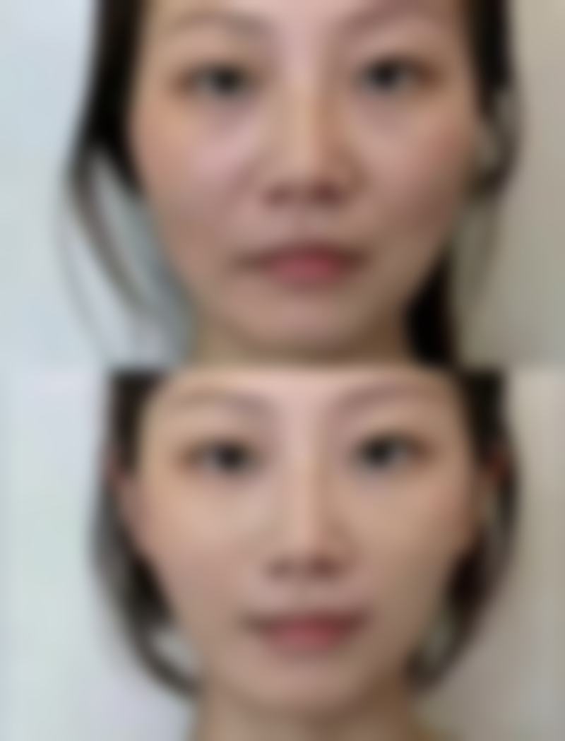 沈阳美莱医疗美容医院肿眼泡割双眼皮抽脂适合我吗？