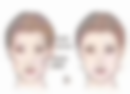 北京圣嘉新医疗美容医院做筋膜恒久无痕双眼皮值不值？