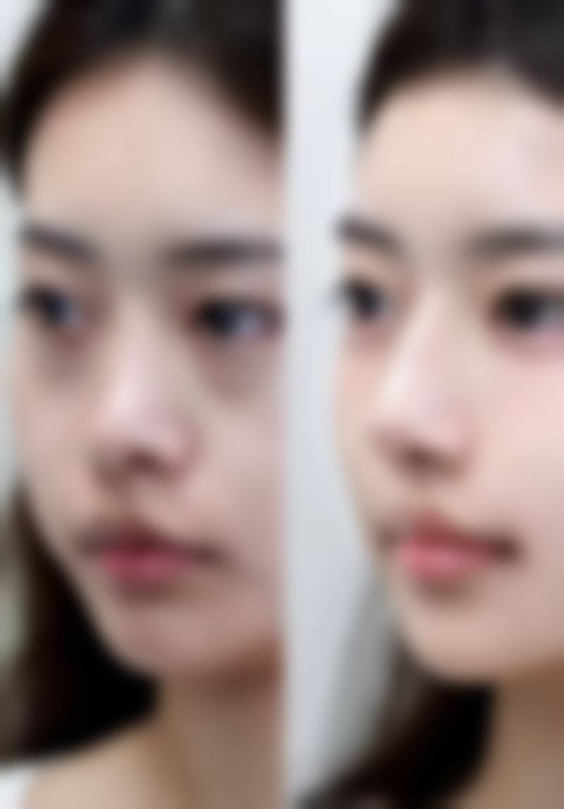 沈阳美莱医疗美容医院手臂吸脂后成效显著所需时间是多久