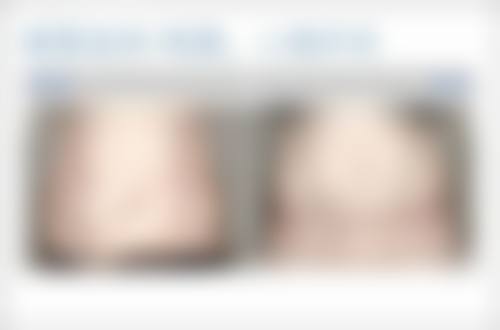 沈阳名流美容医院硅胶隆鼻预防挛缩适合哪些人？