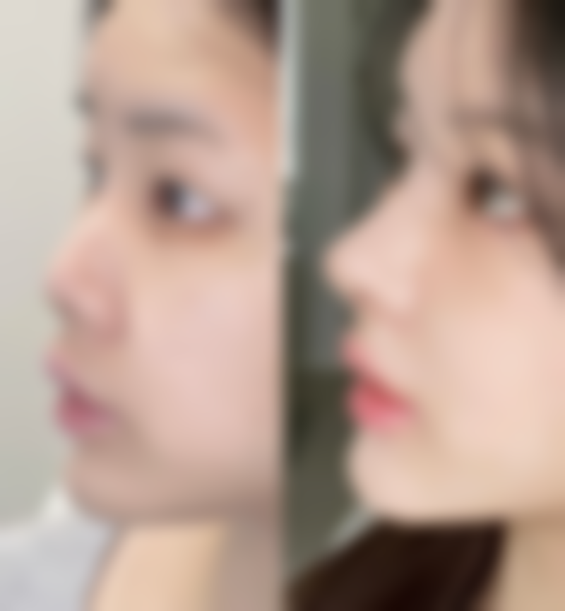 沈阳美莱医疗美容医院抽脂后多久见成效值不值？