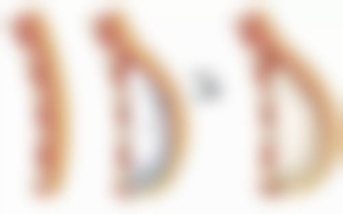 埋线双眼皮不双了怎么办？3种专业修复方法揭秘，让你重拾灵动美眼，告别双眼皮消失烦恼！ 