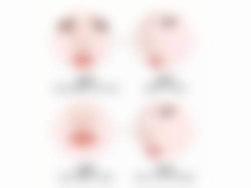 北京画美医疗美容改善埋线双眼皮不双了适合吗