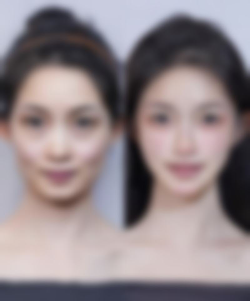 北京画美医疗美容做双眼皮二次手术修复周期长吗？