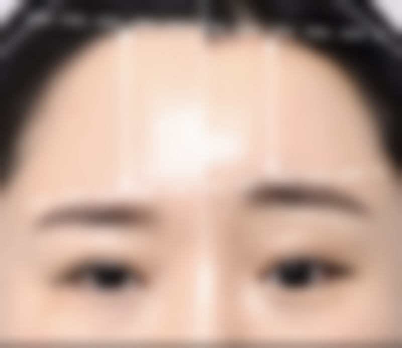 深圳健丽不开刀去眼袋与耳软骨隆鼻取出修复原来样子有啥联系