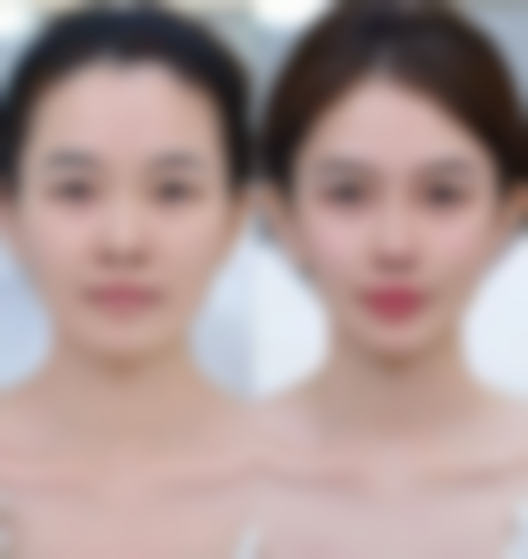 武科 大附属紫荆医院医疗美容科处理埋线双眼皮不双了怎么样