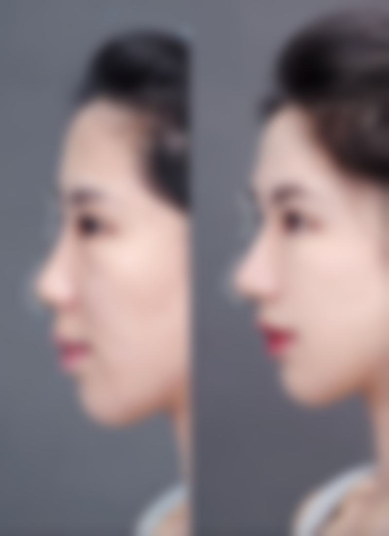 合肥艾蓓缇整形医院真实实例:见证美丽奇迹的发生