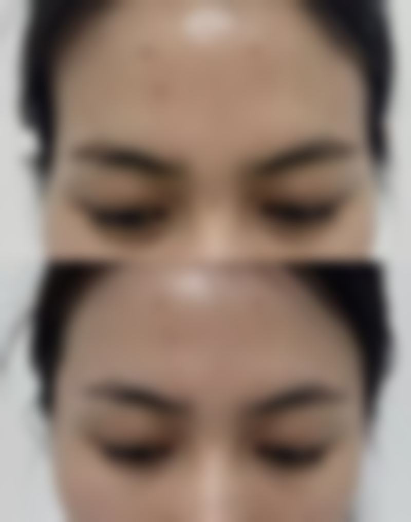 北京画美医疗美容做双眼皮后吃驴肉适合吗