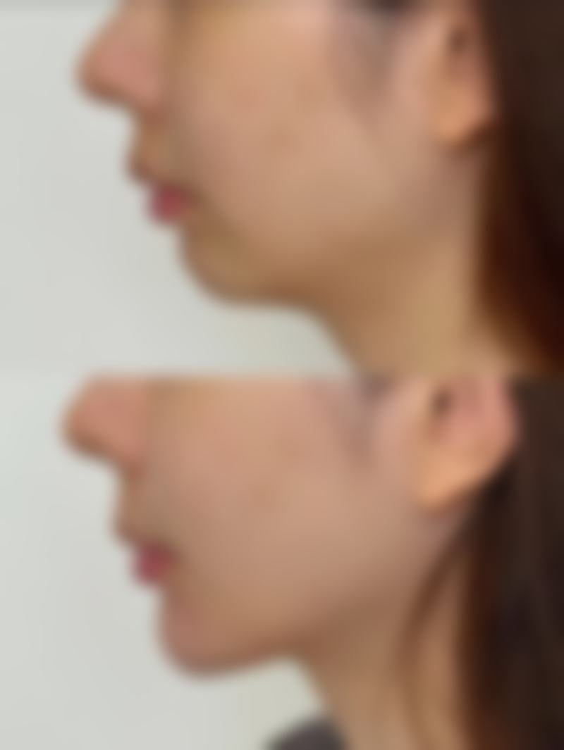 沈阳杏林整形割眼袋手术改变眼部整体状况靠谱吗?