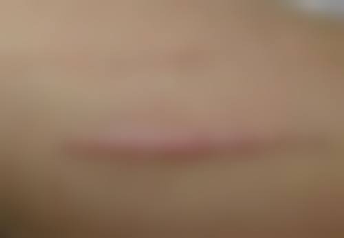 北京嘉禾医疗美容去眼袋适合我吗？