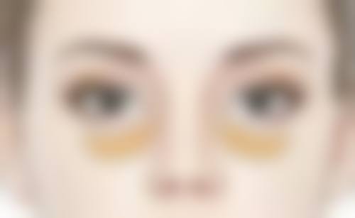 福清东南眼科医院去眼袋值不值？